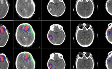 人工智能用于识别不同类型的脑损伤