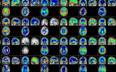 机器学习算法检测Alzheimer的早期阶段