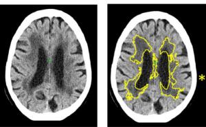 人工智能提高了脑扫描中中风和痴呆的诊断