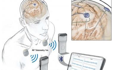 帕金森症:大脑活动被无线记录下来