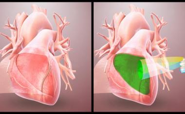 水凝胶可保护心脏免受手术后粘附的侵害