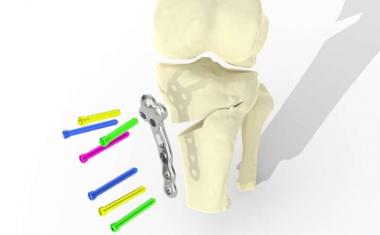 关节炎患者的3D打印膝关节植入物