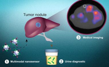 非侵入式试验检测癌细胞