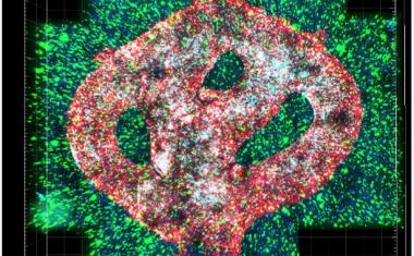 活性胶质母细胞瘤肿瘤首次3d生物打印