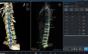 机器人技术增强脊柱手术