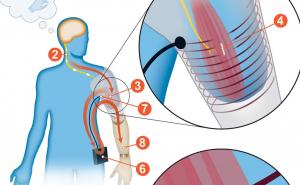 假肢：植入传感器，用于无线控制肌肉信号