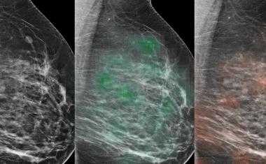 AI和放射科医生的组合准确地确定了乳腺癌