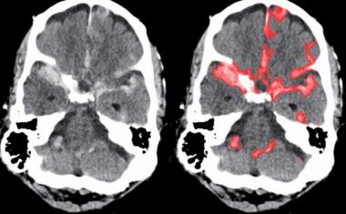 人工智能在检测脑出血方面可与放射科医生竞争