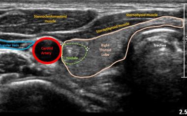 Using AI to predict risk of thyroid cancer on ultrasound