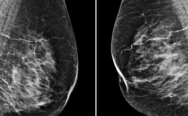 Google-Powered AI斑点乳腺癌
