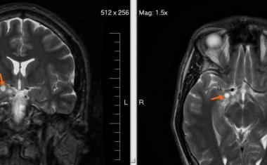 AI＆MRI看着脑肿瘤的基因组