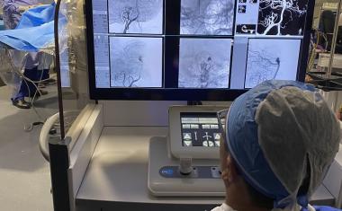 外科医生成功地使用机器人治疗脑动脉瘤