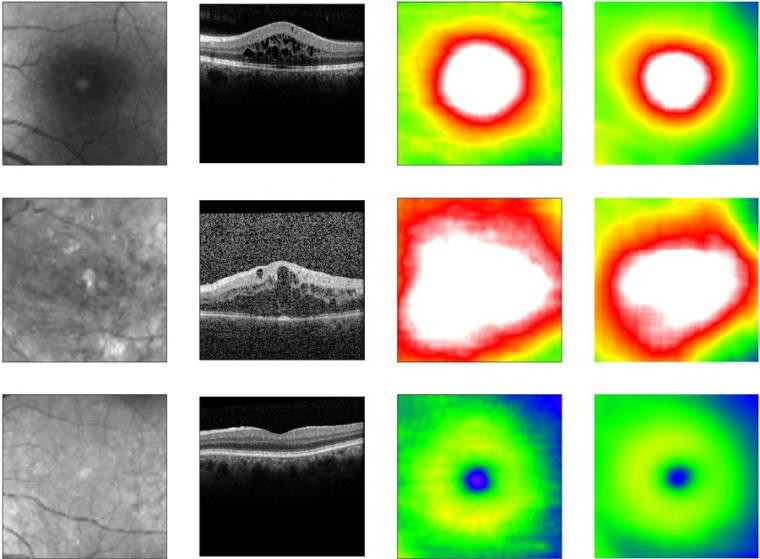眼底图像，OCT图像，视网膜真厚度，预测视网膜厚度。