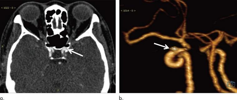 左侧为54岁女性动脉瘤，最大直径2.9 mm。