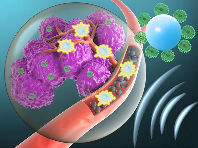 微气泡携带抗癌药物到达肿瘤部位。抗体…