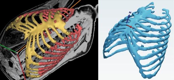 肋骨(红色)和软骨结构的MRI图像分割…