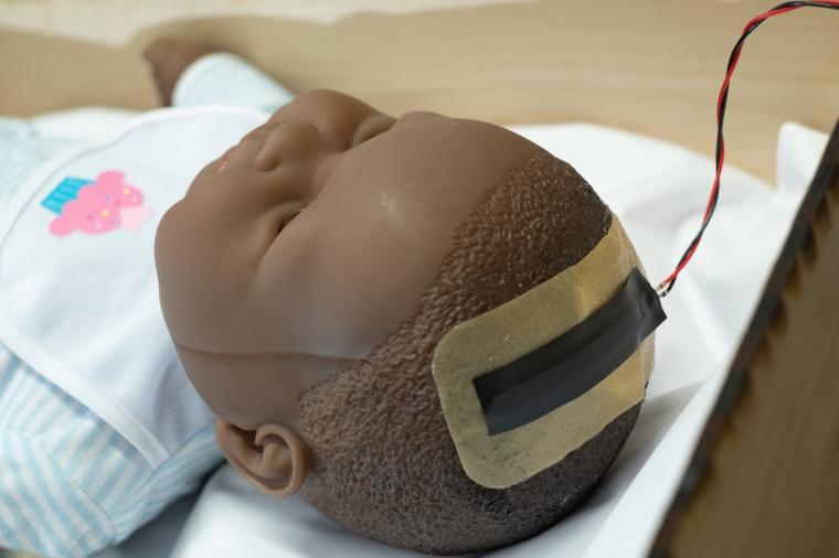 该系统旨在监测颅骨内的高颅内压。