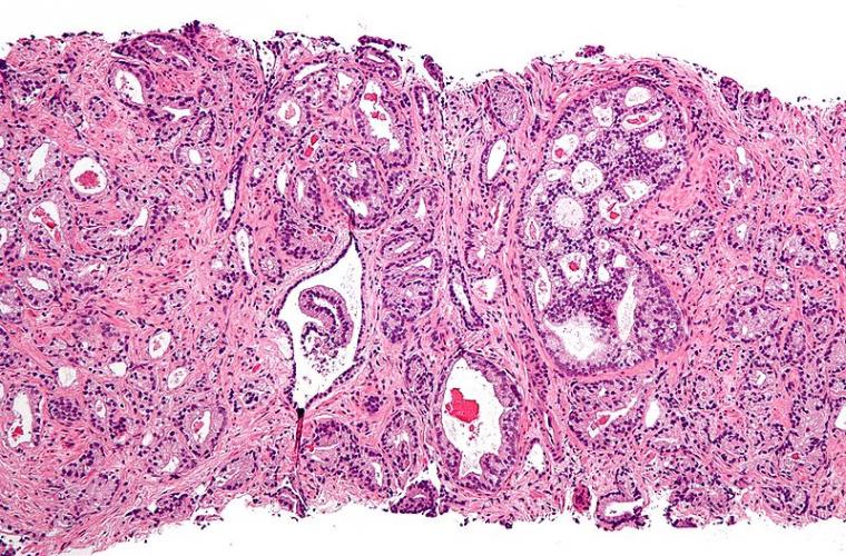 显微照片显示前列腺腺癌腺癌 - 最常见的形式......