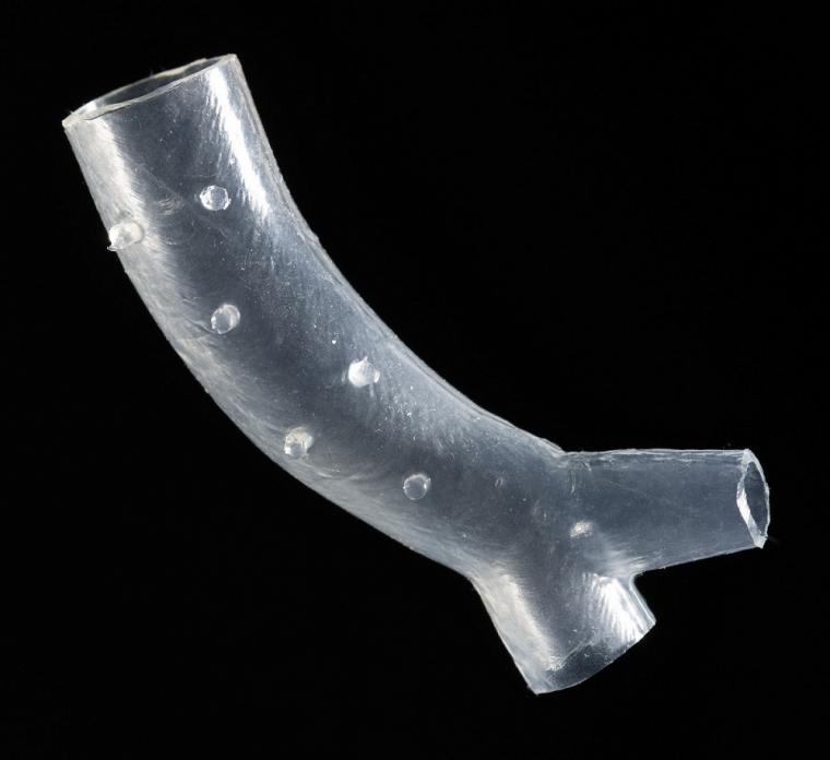 克利夫兰诊所开发了一个病人特异性气道支架的例子。