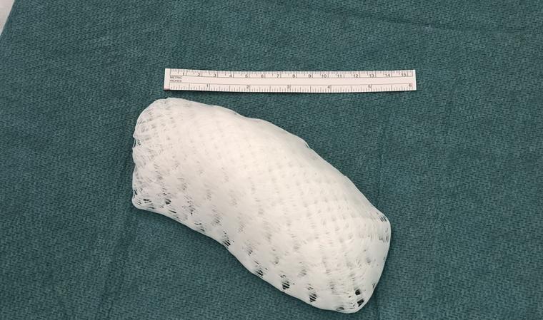 针对患者的3D打印胸部植入物。