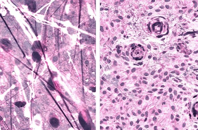 弥漫性星形细胞瘤(左)和脑膜瘤的受激拉曼组织学图像…