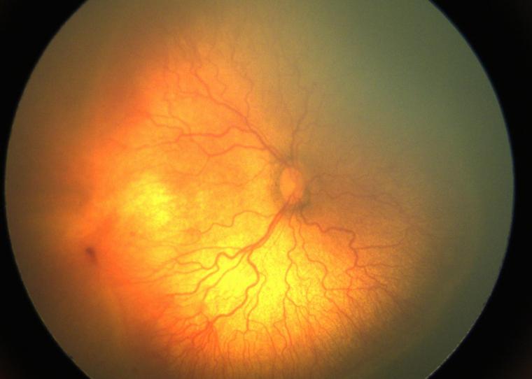 眼底图像显示有侵袭性后视网膜病变的眼睛。“srcset=