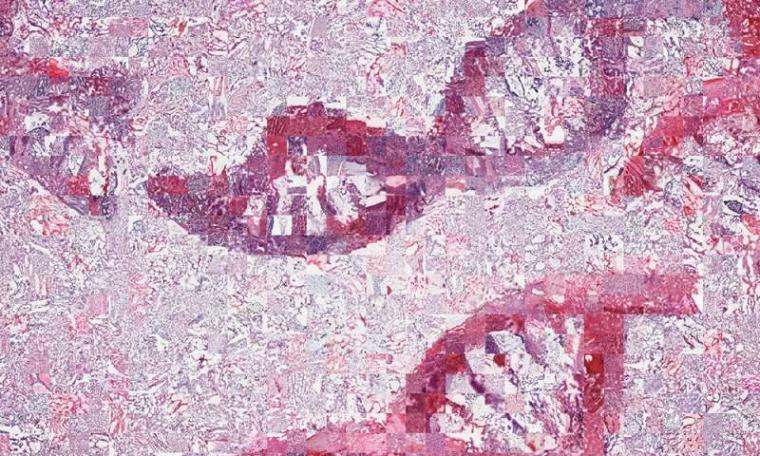 形成破碎的DNA分子的肿瘤显微镜图像的马赛克。